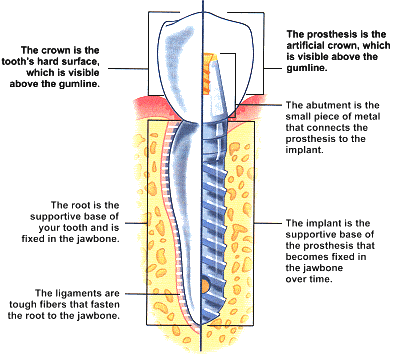 Dental Implant Components