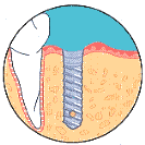 Your first dental implant surgery