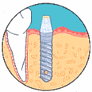 Your second dental implant surgery