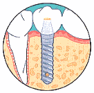 Making and Fitting Your New Teeth