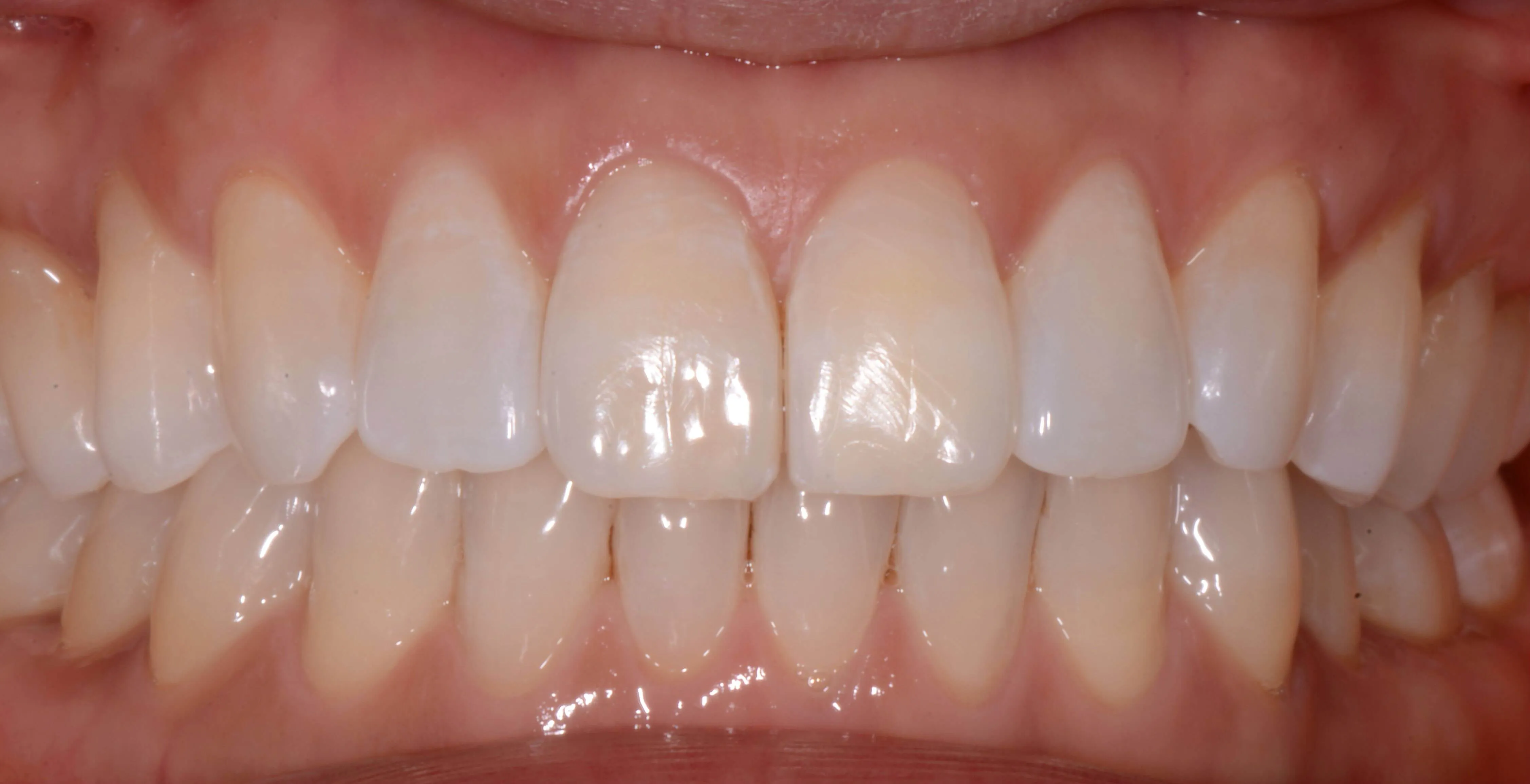 After internal bleeching