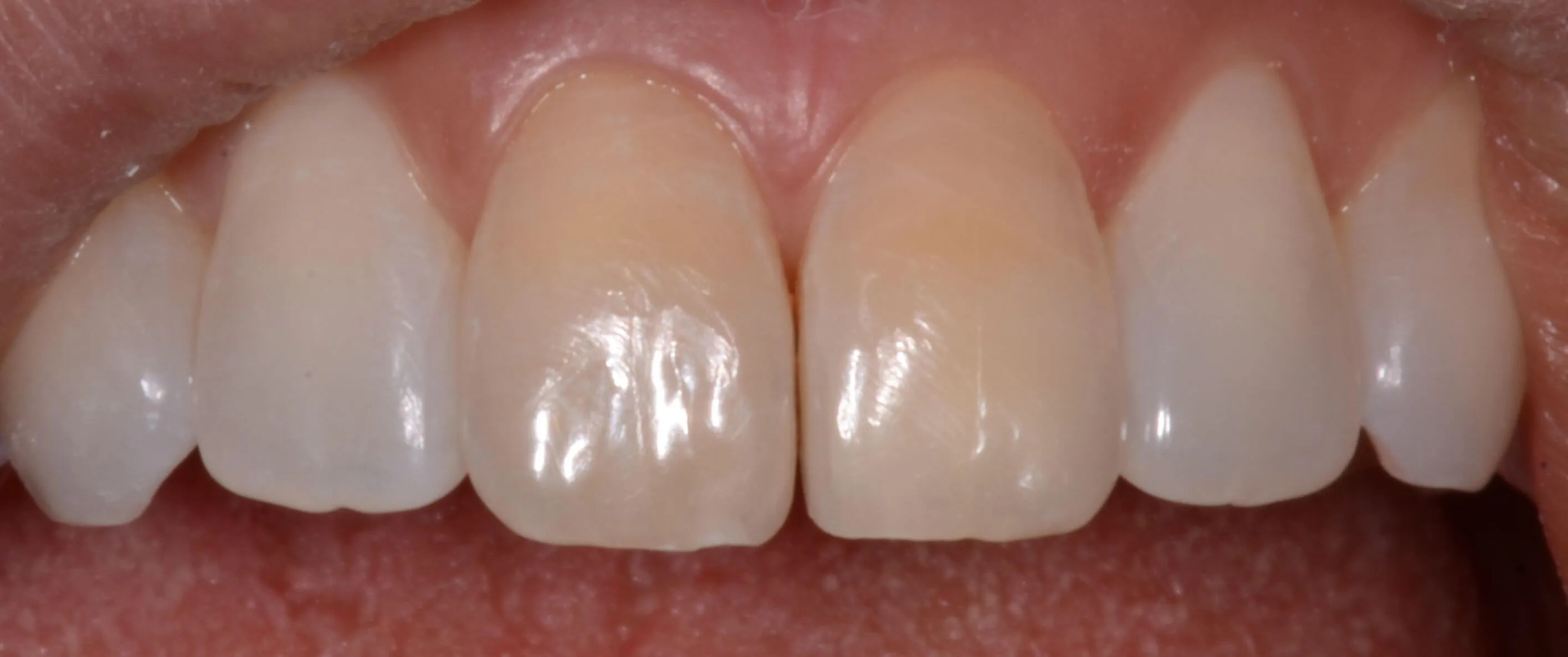 After root canal treatment, before bleeching