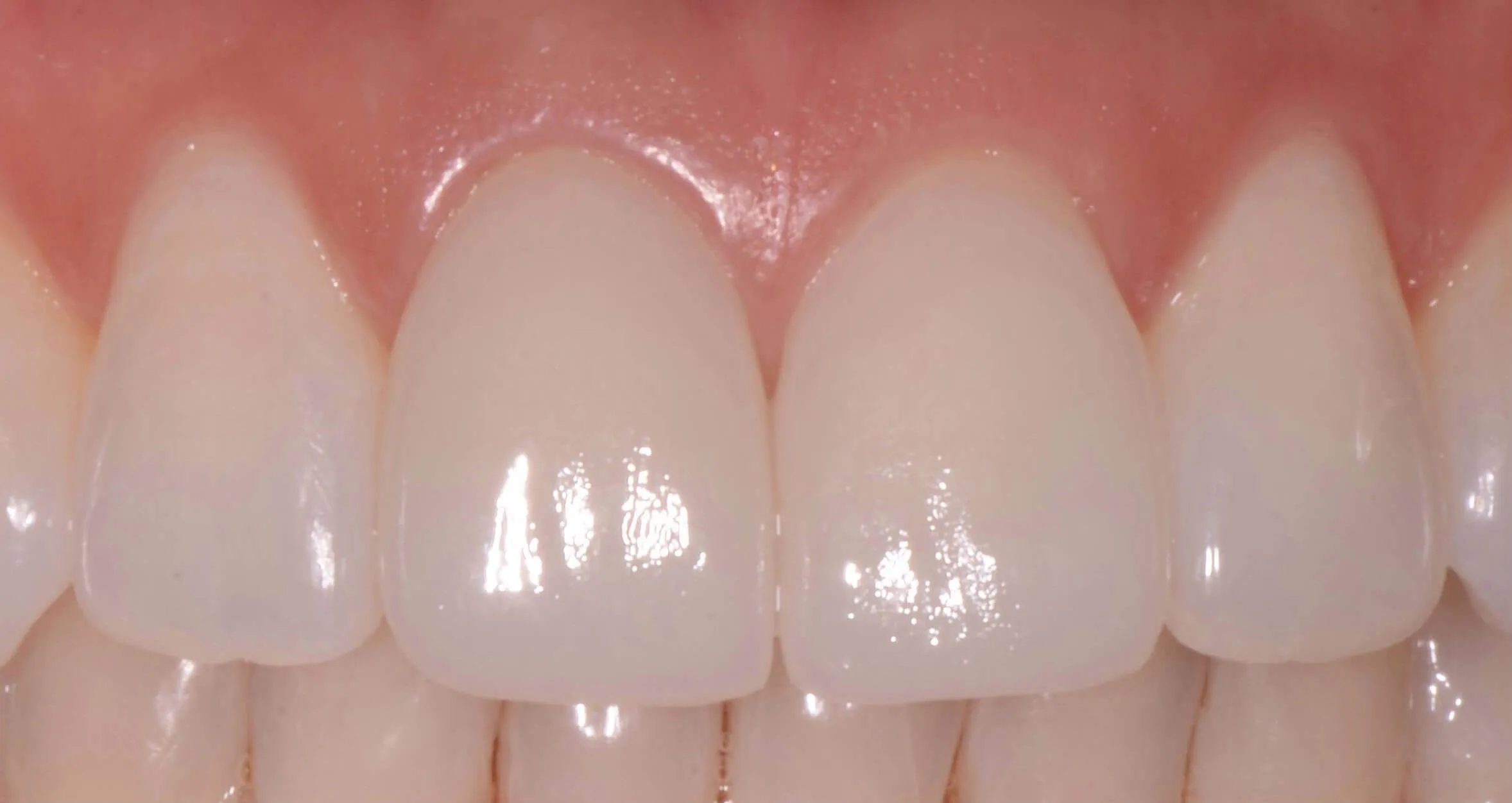 Cerec crowns close up