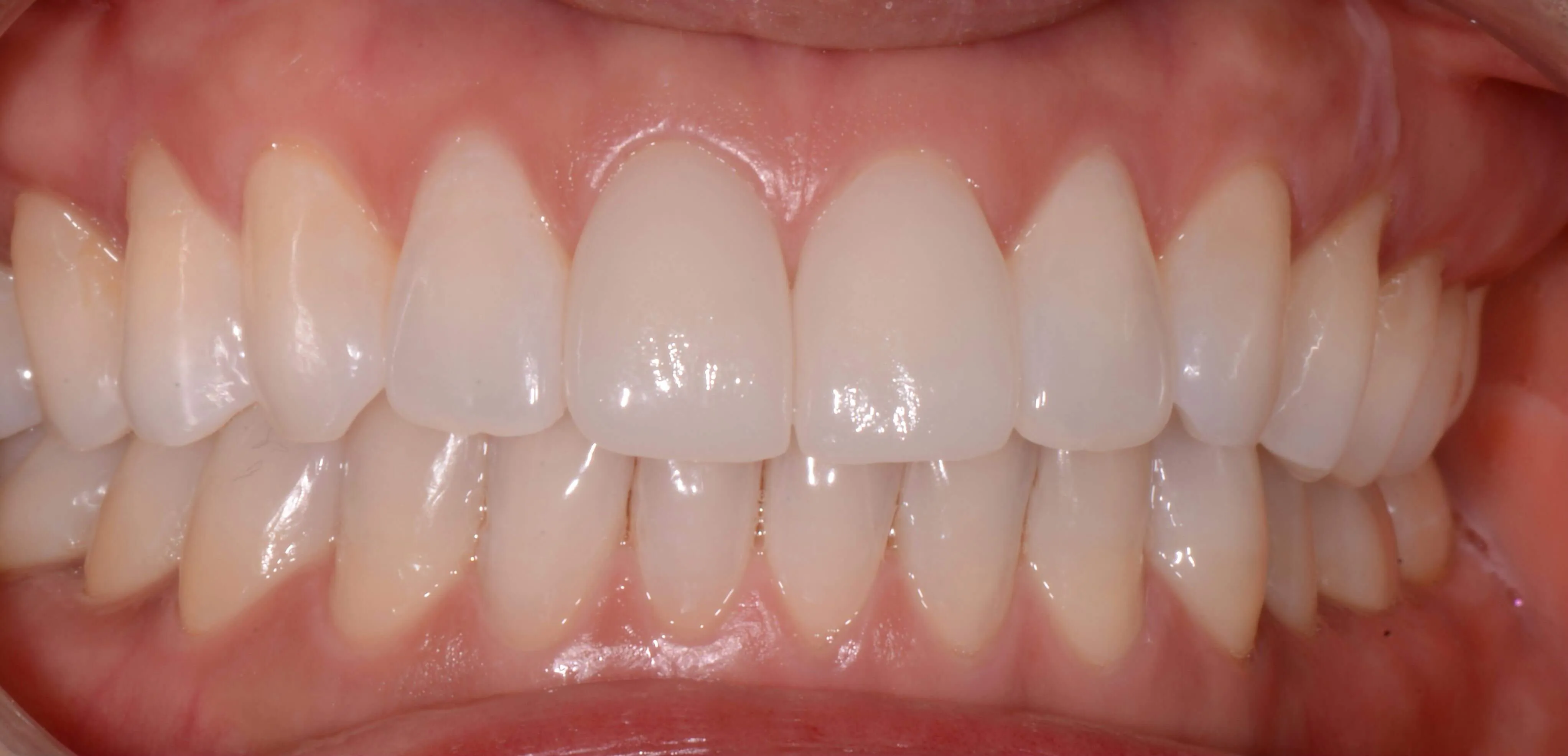 Cerec crowns