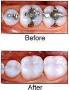 CEREC Fillings