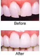 CEREC Veneers