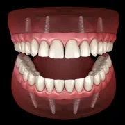 All About Dental Implants