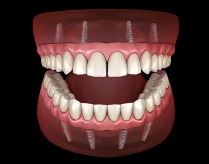 All About Dental Implants