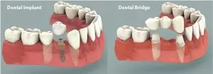 Dental Implants vs Bridges