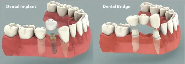 dental_implants_vs_bridges_2015