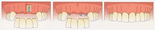 implant_partial_anterior