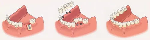 implant_partial_posterior