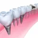Are Dental Implants the Right Choice for You