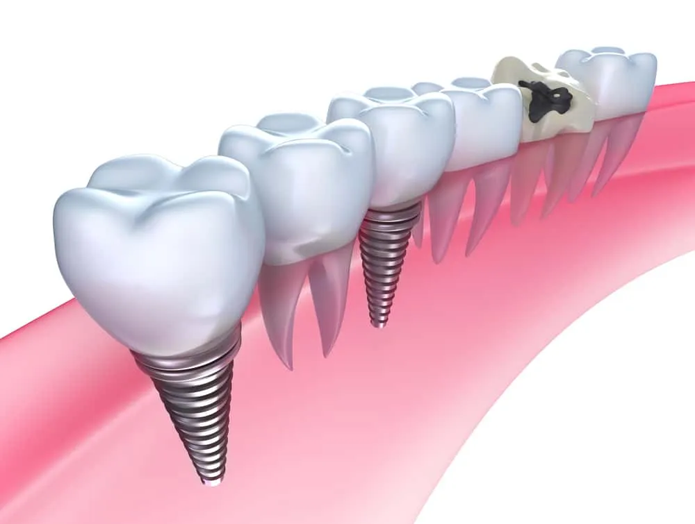 Are Dental Implants the Right Choice for You
