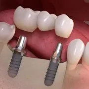 multiple teeth implants dentist specialist midtown nyc