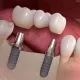 multiple teeth implants dentist specialist midtown nyc