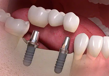 multiple teeth implants dentist specialist midtown nyc