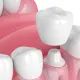 CEREC Dental Crowns
