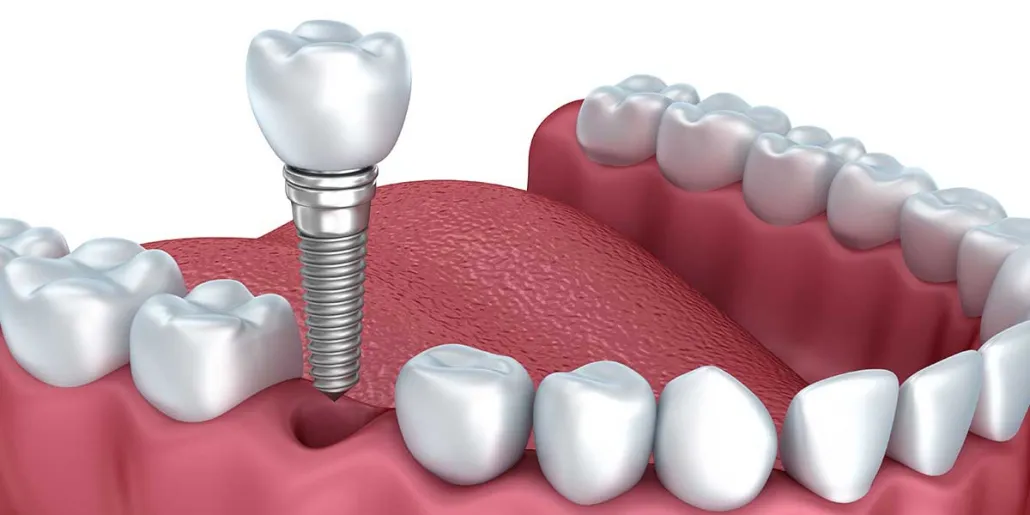 dental implants worth