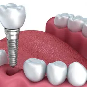 dental implants worth