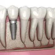 dental implants