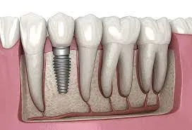 dental implants