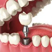 The Benefits of Dental implants