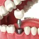 The Benefits of Dental implants