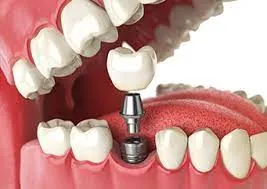 The Benefits of Dental implants