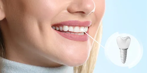 Dental Implants Dental Implants