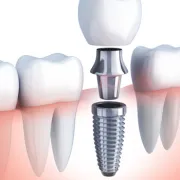 The Benefits of Dental Implants