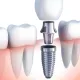 The Benefits of Dental Implants