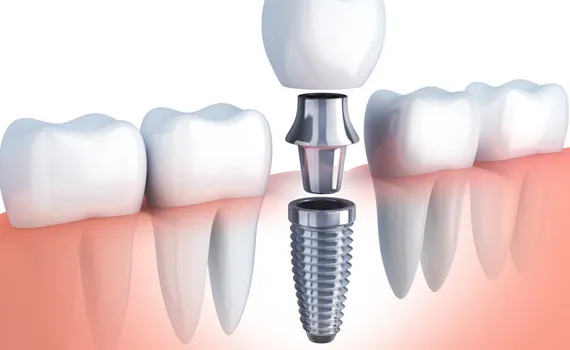 The Benefits of Dental Implants The Benefits of Dental Implants